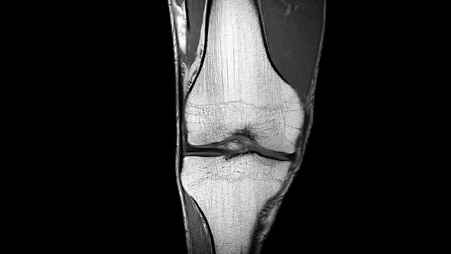 MRI Knee joint or Magnetic resonance imaging for detect tear or sprain of the anterior cruciate ligament.