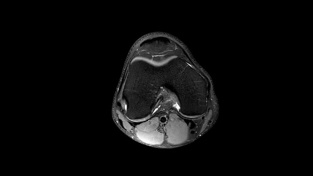MRI Knee joint or Magnetic resonance imaging for detect tear or sprain of the anterior cruciate ligament, ACL.