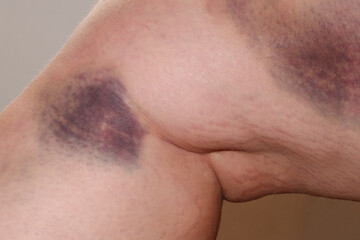 a large bruise on a person's leg. haematoma