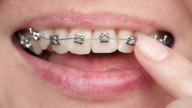 Mouth close-up. The hand touches the bracket system with a finger. Correction of dental bite, orthodontic treatment. Health, dental services.