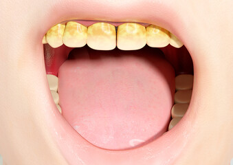 Obraz premium Tartar on human teeth causes calcification of the bacterial plaque that covers the teeth and part of the gums