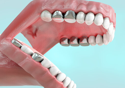 metallic crown prosthesis replacing natural human tooth