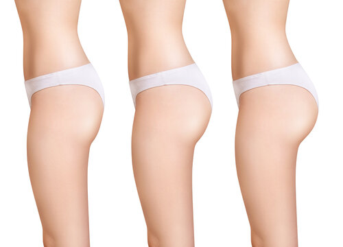 Female buttocks before and after augmentation.