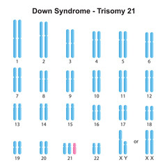 Scientific Designing of Down Syndrome (Trisomy 21) Karyotype. Colorful Symbols. Vector Illustration.
