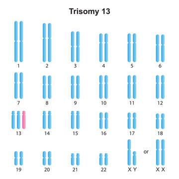 Scientific Designing of Patau Syndrome (Trisomy 13) Karyotype. Colorful Symbols. Vector Illustration.