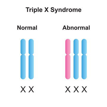 Scientific Designing of Triple X Syndrome (Trisomy X). Colorful Symbols. Vector Illustration.