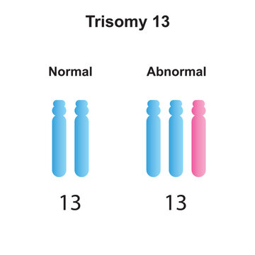 Scientific Designing of Patau Syndrome (Trisomy 13). Colorful Symbols. Vector Illustration.