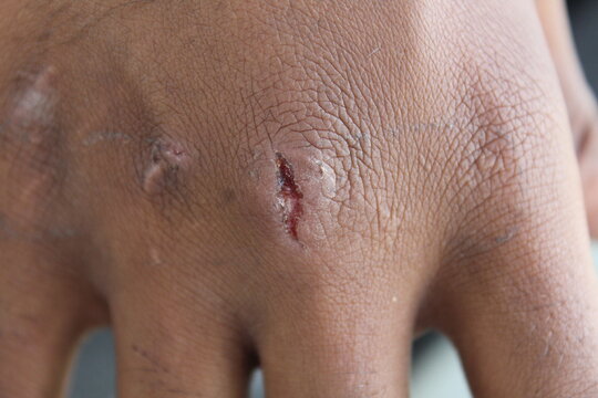 wound on hand, hand with a cut on the hand