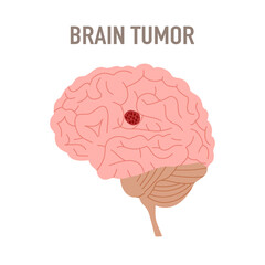 Brain tumor disease in flat design vector illustration.