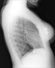 Lateral chest x-ray of a woman with breast expanders following breast cancer surgery