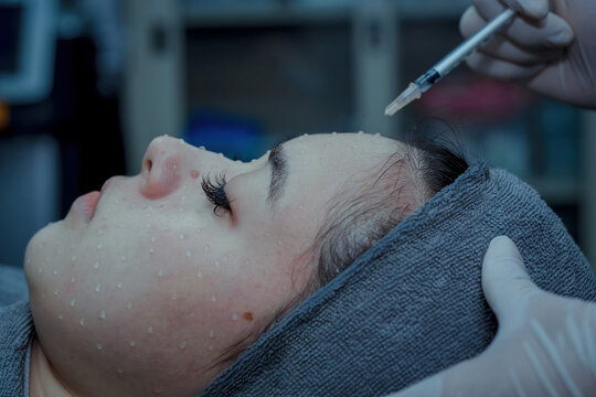 Needle mesotherapy. Microneedle meso therapy, treatment woman at the beautician spa salon. Space for text. Fresh and clean skin face.Skin care and treatments concept.