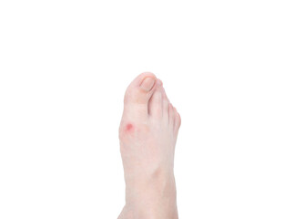 Obraz premium the foot with the ointment