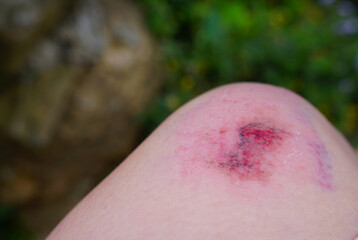 Visible new accident scratches on human knee