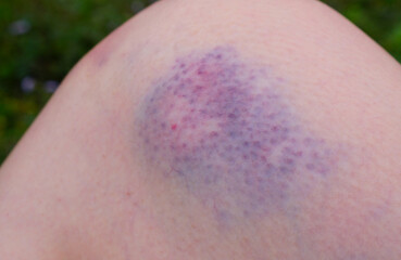 Fototapeta premium Visible purple bruise on knee after accident