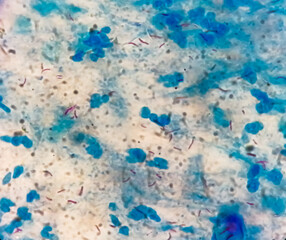 Sputum or phlegm smear AFB stain under microscopy showing Macrobacterium Tuberculosis Bacteria...