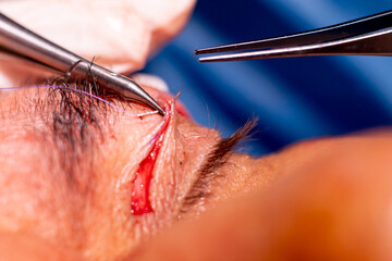 basra, iraq - August 12, 2022: closeup photo of blepharoplasty eyelid surgery