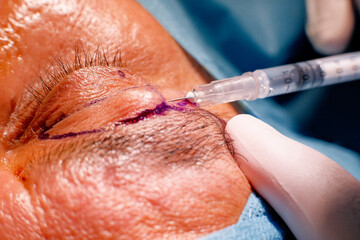 basra, iraq - August 12, 2022: closeup photo of blepharoplasty eyelid surgery