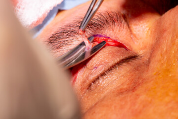 basra, iraq - August 12, 2022: closeup photo of blepharoplasty eyelid surgery