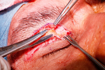 closeup photo of blepharoplasty eyelid surgery