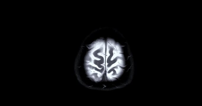 MRI Brain can help doctors look for conditions such as bleeding, swelling, tumors, infections, inflammation, damage from an injury or a stroke diseases.