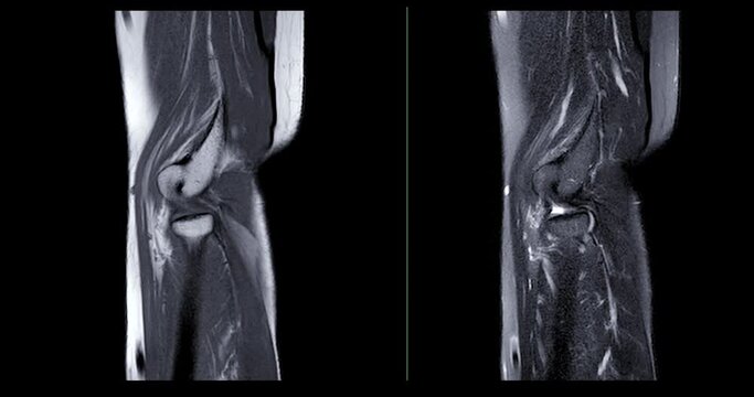 MRI elbow joint  for Evaluation of the elbow by magnetic resonance imaging (MRI) is To facilitate accurate diagnosis.