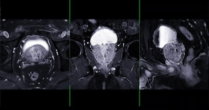 MRI prostate gland for diagnosis  prostate cancer cell and evaluate the extent of prostate cancer  in aged men.
