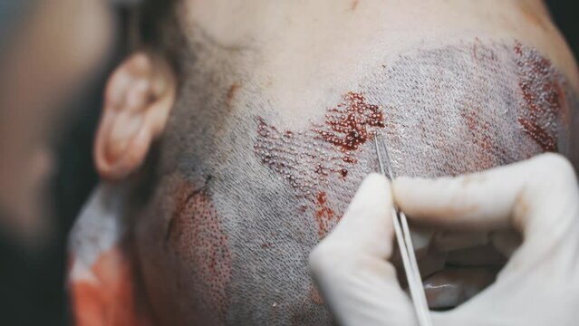 Doctors collecting hair follicle extraction. FUE Hair Transplant Patient in Clinic.