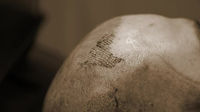 Doctors collecting hair follicle extraction. FUE Hair Transplant Patient in Clinic.