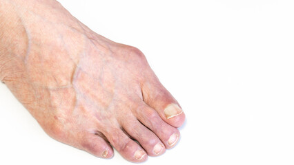 Bunion or hallux valgus on senior woman foot. Deformity of the joint connecting the big toe to the...