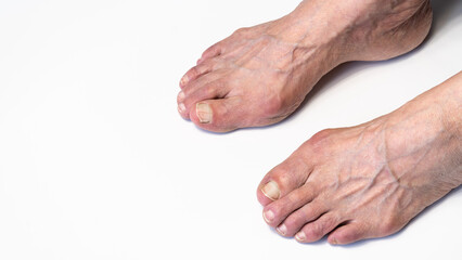 Bunion or hallux valgus on senior woman foot. Deformity of the joint connecting the big toe to the...