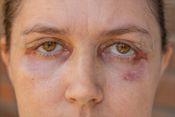 Fototapeta premium Double Eyelid Surgery, Eyes Surgery Recover Period, immediately after plastic surgery. Eyes After Eyelid Surgery