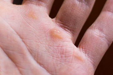 Calluses, skin injury on the hand close-up