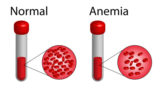 Iron deficiency anemia. The difference of Anemia amount of red blood cell and normal. Realistic vector 3d picture. Vector illustration isolated on white background