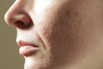Extreme close-up of texture of problematic human skin with large-looking open pores, acne scars ...