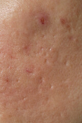 Fototapeta premium Extreme close-up of texture of problematic human skin with large-looking open pores and acne scars