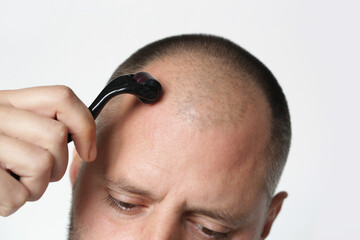 Men using microneedle derma roller on head for stimulating new hair growth. Simple and cheap...