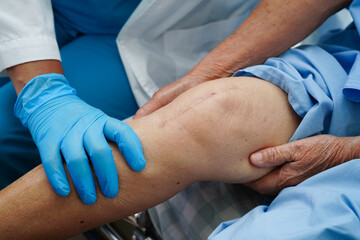 Doctor checking Asian elderly woman patient with scar knee replacement surgery in hospital.