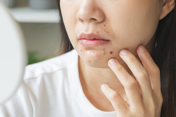 Expression worry asian young woman looking at mirror touching pustule around the chin and mouth, allergic when wear mask, spot scar from pimple on face. Beauty care, skin problem by acne treatment.