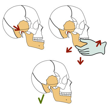 Reduction of the temporomandibular joint. Vector illustration