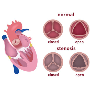 Stenosis Of The Aortic Valve Of The Heart. Disease Infographic. Vector Illustration