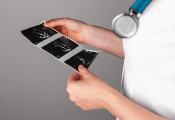 Heart ultrasound, cardiac scan, checkup result studying, holding in doctor hand