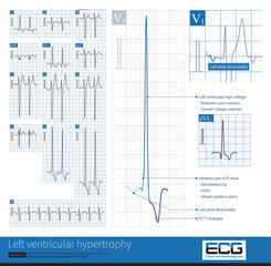 In left ventricular hypertrophy, R wave amplitude in lead V5 and S wave amplitude in lead V1 increased, accompanied by left axis deviation and left atrium abnormality.