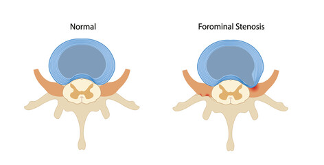 Forominal stenosis lumbar illustration. Nerve root compressed.  - obrazy, fototapety, plakaty