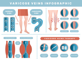 Varicose infographic. Venous disease medical health problems with human blood venous recent vector template set - obrazy, fototapety, plakaty