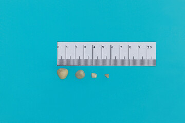 Four gallstones close up on blue background next to a ruler