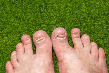 toes of a man with a fungal nail disease