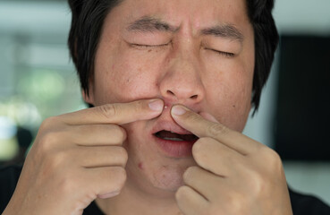closeup acne on face, skin problem, scar and oily on face