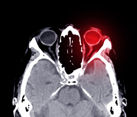 CT scan of the brain sagittal view  for diagnosis brain tumor,stroke diseases and vascular diseases.