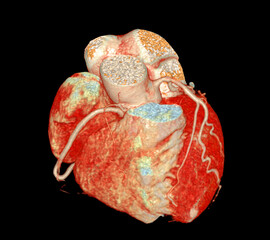 CT Cardiac 3D or CTA coronary artery for prevention and screening coronary artery diseases.