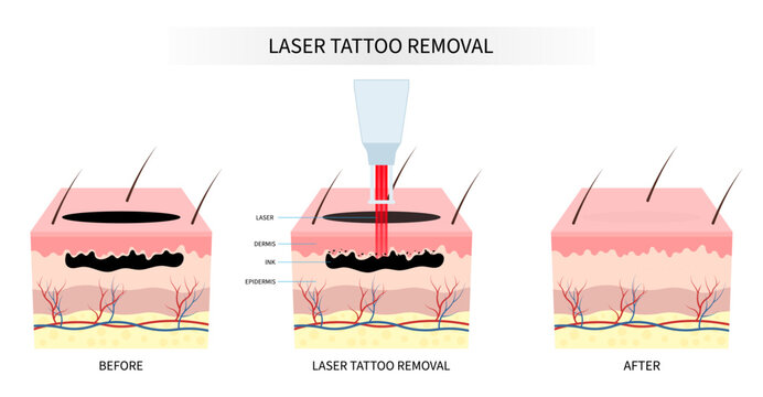 skin tattoo remove surgery